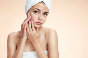 Tinh dầu tràm trà trị mụn có tốt không? Cách sử dụng tinh dầu tràm trà