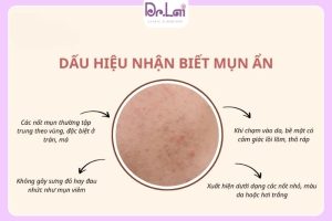 Trị Thâm Mụn Bằng Phương Pháp Laser IPL Có Hiệu Quả Không? Giải Pháp Làm Mờ Thâm Được Nhiều Người Quan Tâm