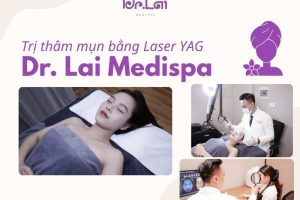 Trị Thâm Mụn Bằng Phương Pháp Laser YAG Có Hiệu Quả Không? Giải Pháp Được Nhiều Người Quan Tâm